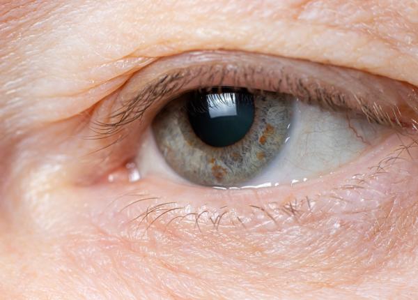 pleoapele cazute si bolile pe care le ascund ioana moldovan fata arata trist imbatranita prematur te machiezi greu