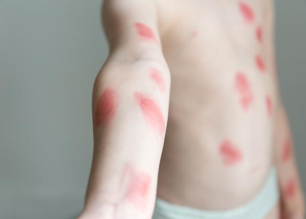 variola maimutei bilant 23 iunie al saselea caz confirmat in romania