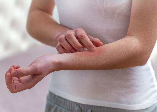 eczemele specifice tinerilor medic le afecteaza profund calitatea vietii