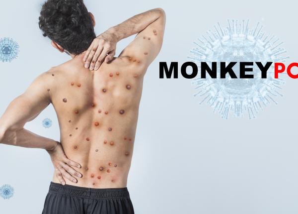 variola maimutei bilant 28 iunie 2022 9 cazuri diagnosticate in romania