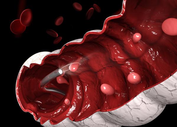 2 treimi din tumorile endocrine localizate in tractul digestiv poiana au fost numite carcinoide dar s a demonstrat ca aceste tumori pot fi cancere adevarate