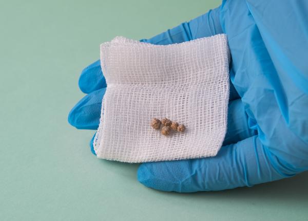 colecistul care e cauza si cand se scoate pietrele mici pe colecist mai periculoase decat pietroaiele