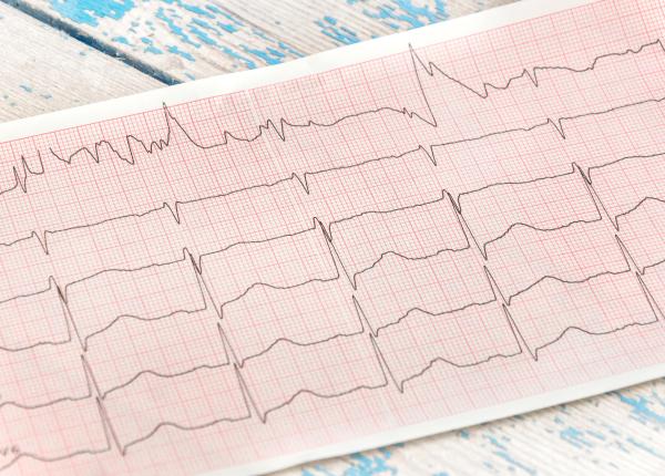 cum recunosti un infarct pe ekg electrocargiograma