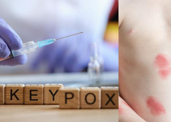 variola maimutei la un pas de urgenta sanitara globala oms apel la actiune urgenta amenintare pentru sanatate