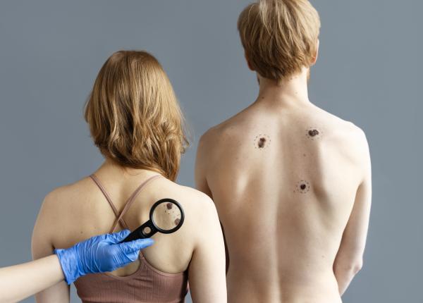 cand este necesar screening ul pentru cancerul de piele patru situatii alarmante