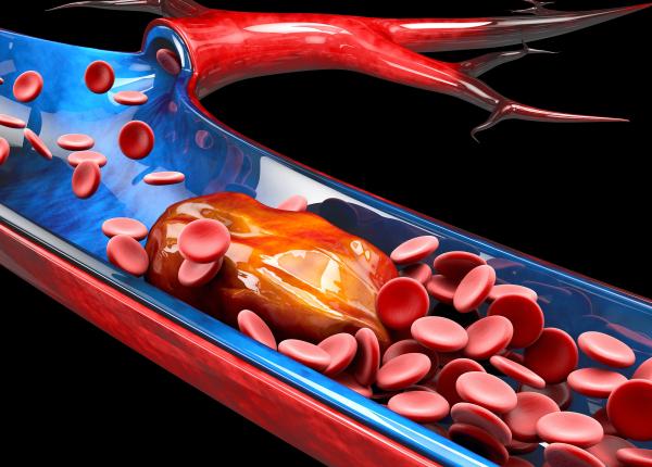 cheag de sange in corp ce este si cum stii daca l ai moarte subita 1 din 4 persoane moare fara avertisment