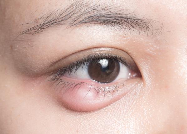 urciorul si chalazionul afectiunile oculare cu simptome similare cum le deosebim