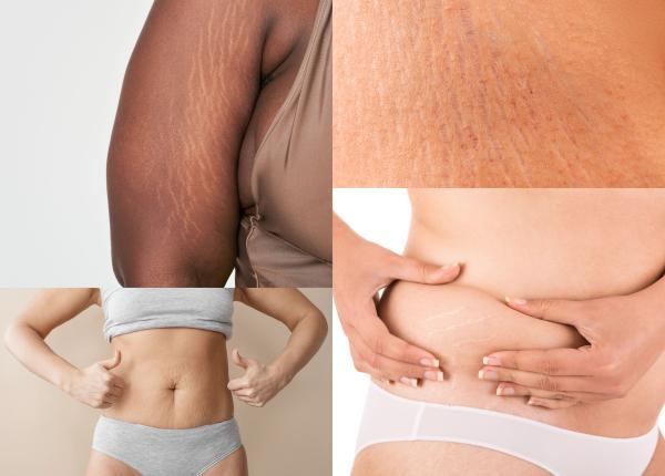 vergeturile de doua tipuri albe si rosii care e diferenta si cum le facem sa dispara ioana marinescu 2 produse geniale