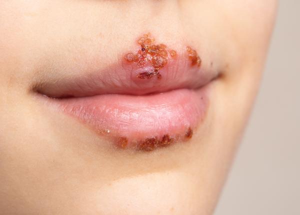 aftele bucale cauze si tratament medic persoana se simte atacata printr o remarca negativa sau critica ce ii provoaca o suferinta superficiala dar vie deranjanta