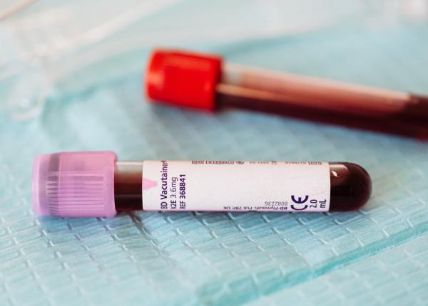 testul banal si ieftin pentru diagnosticarea cancerului de prostata medic nu mai este o boala din care se moare