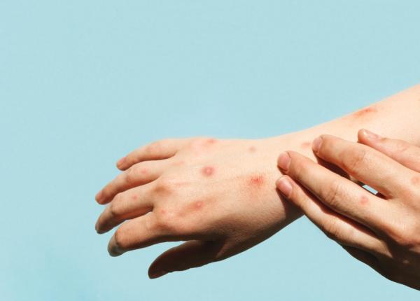 variola maimutei bilant 7 iulie 2022 alte trei noi cazuri