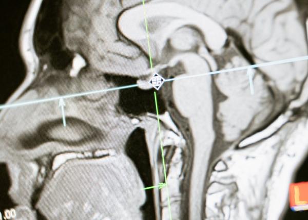 prof vlad ciurea explica legatura dintre tehnologie si neurichirurgie este pas de pas exact ca intr o casatorie suntem mana in mana