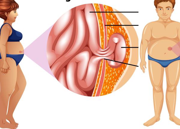 hernia hiatala cauze simptome tratament care e legatura cu refluxul gastroesofagian o poti avea si sa traiesti fericit pana la adanci batraneti