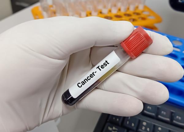 markerii tumorali asociati cu cancerul ce trebuie sa stii