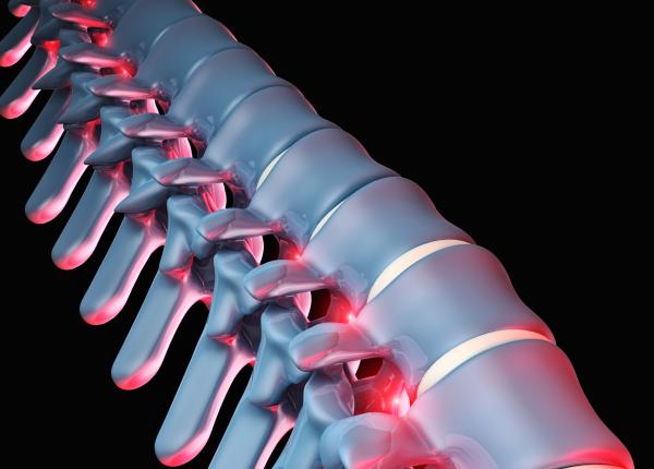 hernia de disc cauze si tratatament medic este tot mai prezenta in viata oamenilor poate cauza dureri majore lasata netratata poate duce la complicatii grave