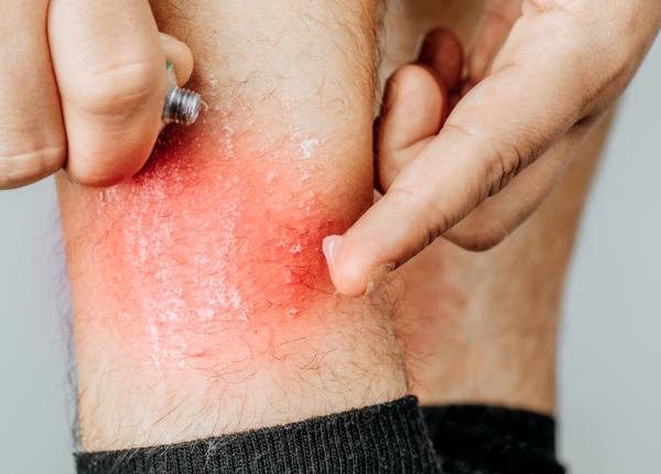 pruritul senzatia de mancarime a pielii simptom al batranetii ce trebuie sa stii