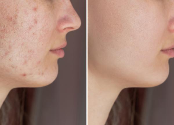 colageneza solutia care te scapa de urmele lasate de cosuri marinescu inseamna vindecare este foarte important