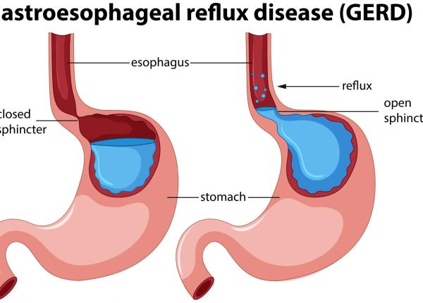 care sunt simptomele refluxului gastroesofagian si ce sa te trimita urgent la medic buliga oamenii tusesc si nu stiu de ce