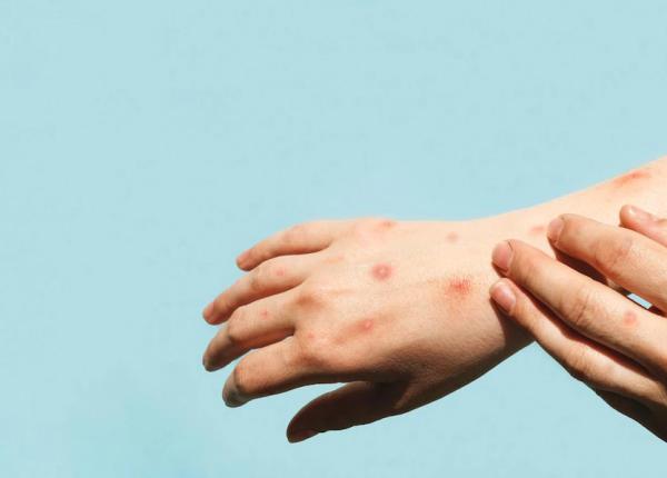 primul copil infectat cu variola maimutei avertismentul medicilor poate fi prezent in populatia generala