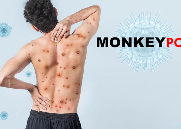 variola maimutei inca un caz confirmat in romania s a ajuns la 20