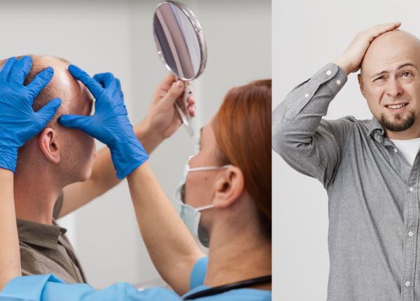 chelia la barbati ce sa faci daca ti cade parul ce sa stii despre minoxidil si transplant nu aruncati banii pe suplimente si tehnici care nu vor merge