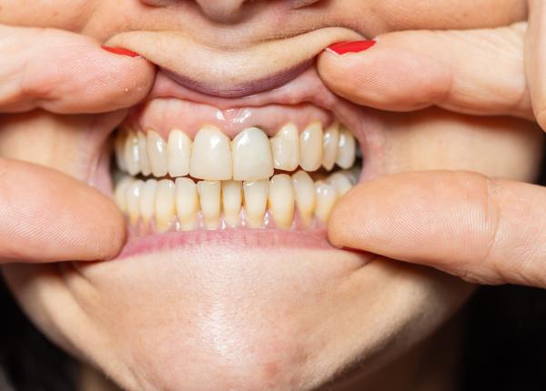 retractia gingivala ce este simptome cauze tratament iancu retractia gingivala ce este simptome cauze tratament iancu