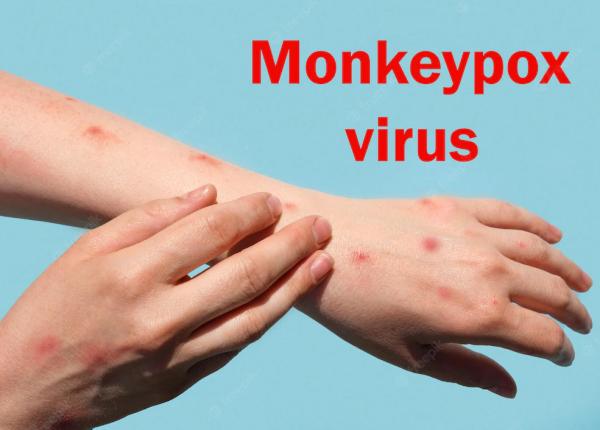 variola maimutei inca un caz confirmat in romania s a ajuns la 21