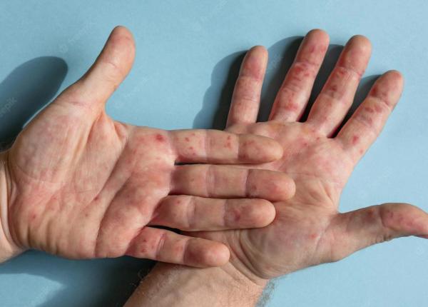 eczema dishidrotica simptome si tratament stresul unul dintre factorii de risc