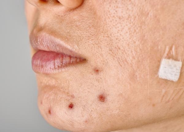 foliculita cauze si tratament poate aparea de la epilat barbierit sau igiena precara