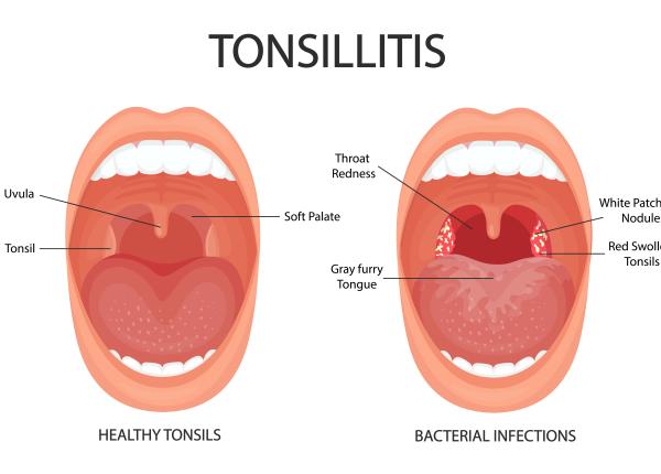 pietrele pe amigdale cauze si simptome cum se indeparteaza corect greseala care duce la aparitia lor