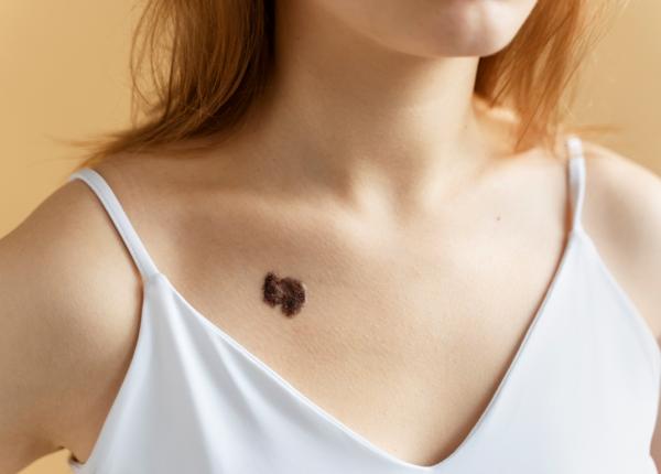 cand este recomandata indepartarea unei alunite medic este potential periculos si se doreste excizia pentru a evita controale repetate