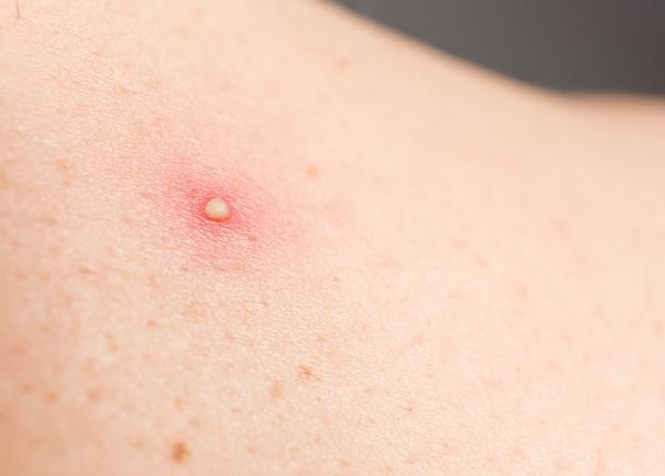 furunculul infectia firelor de par cand e cazul sa te alarmezi