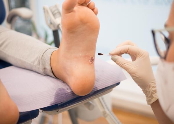 negii semnele infectiei cu virusul hpv cum se trateaza bubitele contagioase