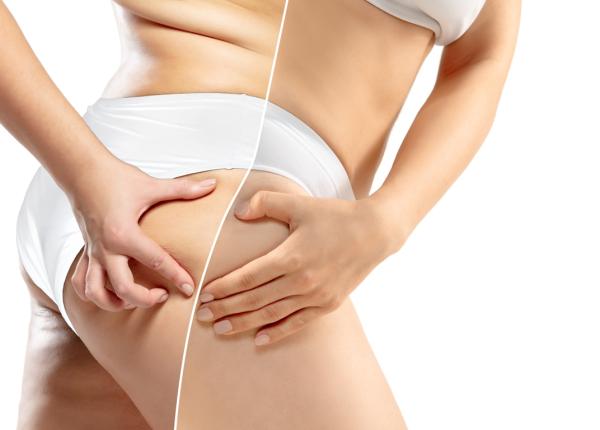 celulita debut in adolescenta cu efecte pe termen lung medic ceva minune nu exista