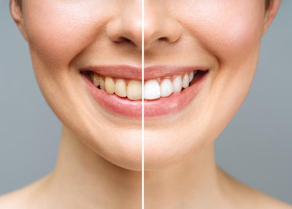albirea dentara metode si cine nu o poate face 5 alimente care strica si ingalbenesc dintii iancu lamaia bicarbonatul capsunile nu sunt bune lezeaza gingia albirea dentara metode si cine nu o poate face 5 alimente care strica si ingalbenesc dintii iancu lamaia bicarbonatul capsunile nu sunt bune lezeaza gingia