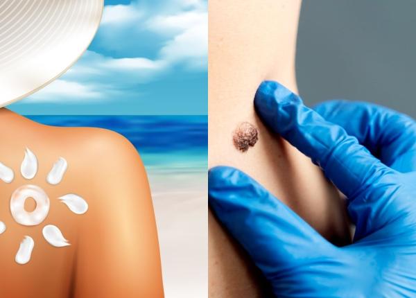 cancerul de piele date ingrijoratoare cati romani mor din cauza bolii