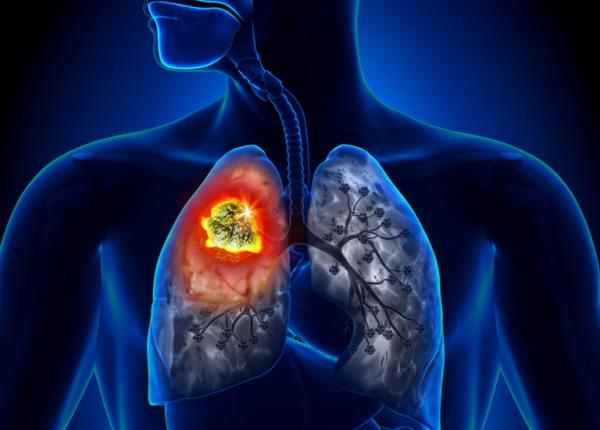 tuberculoza cauze simptome si tratament medic potential fatal daca nu este tratata la timp