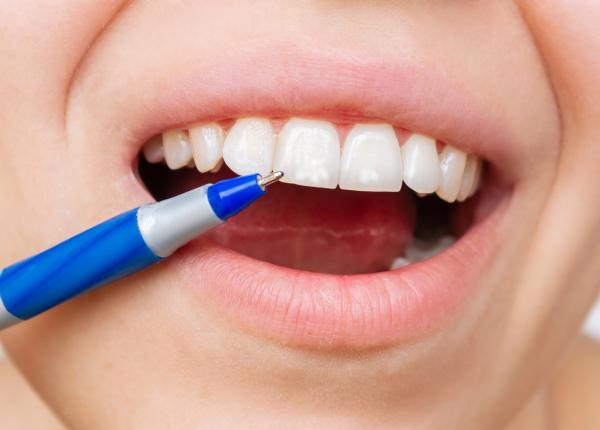 fluoroza dentara fluor pe dinti sau pete pe dinti cauze tratament fluoroza dentara fluor pe dinti sau pete pe dinti cauze tratament