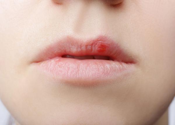 planta care te scapa de herpes lidia fecioru se retrage instantaneu