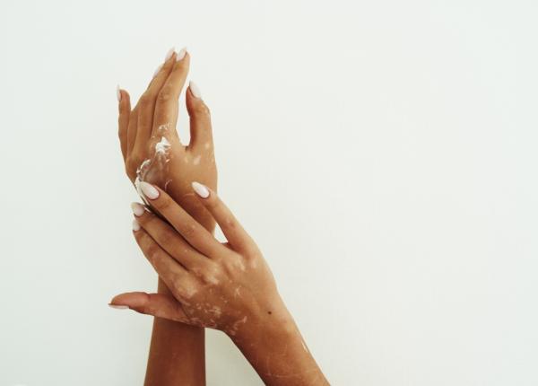 opzelura tratament revolutionar pentru vitiligo efecte vizibile in 24 de saptamani