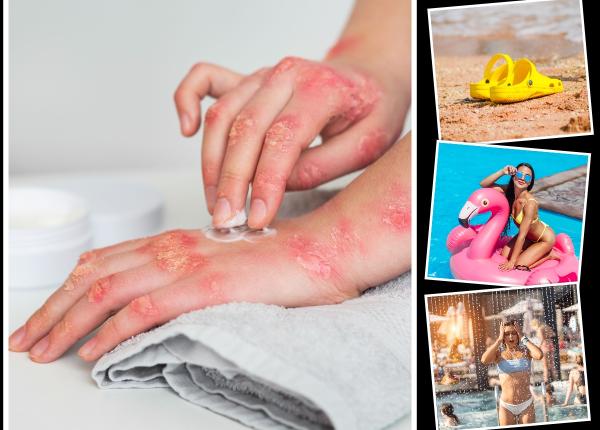 bolile de piele frecvente vara medic clorul si alte substante dezinfectante utilizate pentru curatare pot provoca tot felul de alergii