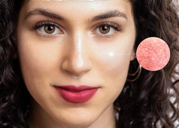 pigmentarea pielii consecinta a expunerii la soare medic poate trada imbatranirea cutanata si se poate asocia cu alte probleme