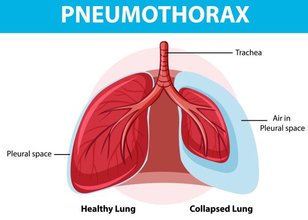 pneumotoraxul cauze tratament si complicatii medic debutul este brusc poate pune in pericol viata pacientului