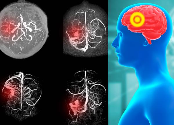 anevrismul cauza mortii subite plesneste in cap