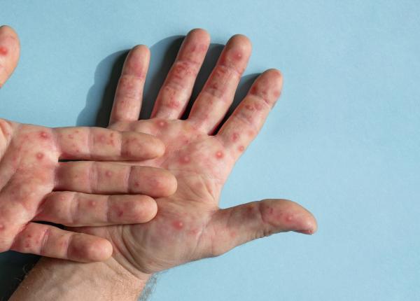 variola maimutei eliminata in europa oms trebuie sa ne intensificam urgent eforturile