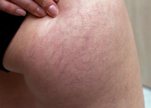 flebita cauze si tratament de ce apare inflamatia venelor