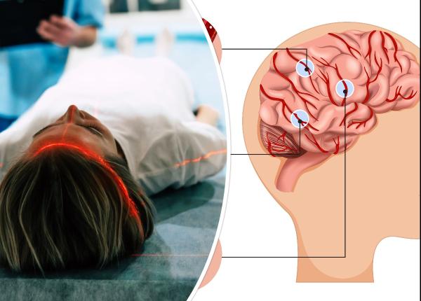 avc doua tipuri analiza care arata daca creierul e pierdut