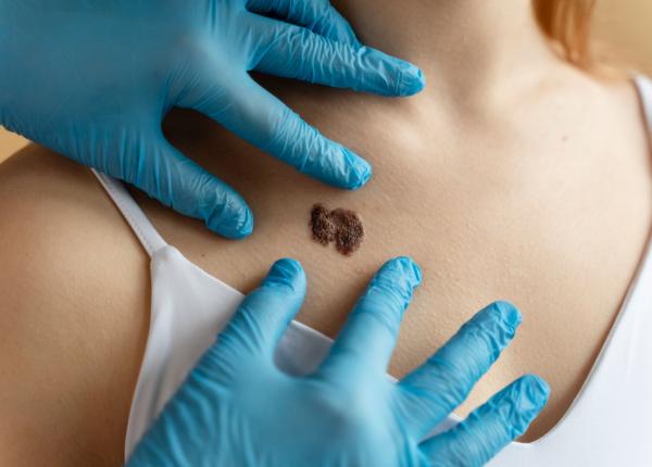 melanomul mai putin frecvent dar mai periculos dr simionescu rata sa de supravietuire este cea mai sumbra melanomul mai putin frecvent dar mai periculos dr simionescu rata sa de supravietuire este cea mai sumbra