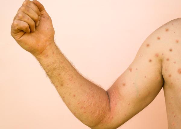 varicela la adulti riscuri pot aparea complicatii grave boala poate fi prevenita prin vaccin