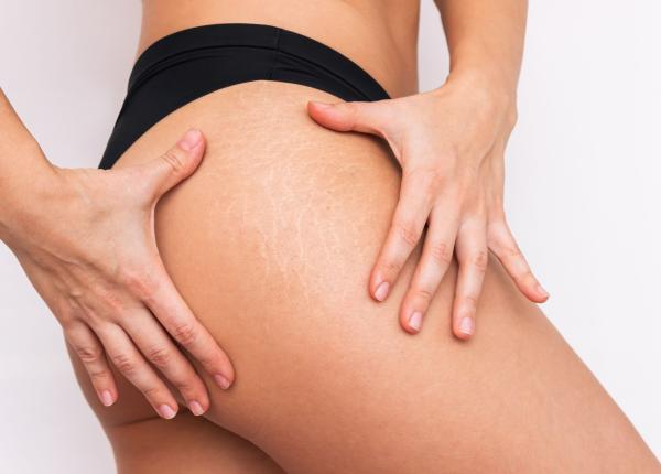 adevarul despre vergeturi dermatolog mituri